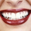 How Long Does Teeth Whitening Last