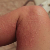 How Long Does Hives Last