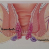 How Long Does It Take For Hemorrhoids To Heal